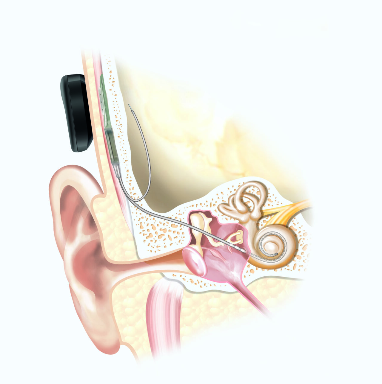Cochlear Implant AudioHearing Melbourne