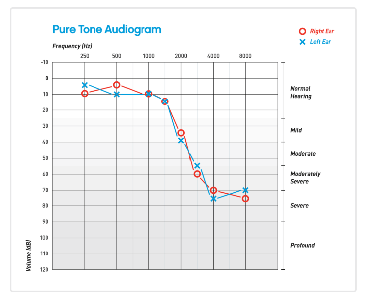 Severe-High-Fequency-Hearing-loss-audiogram